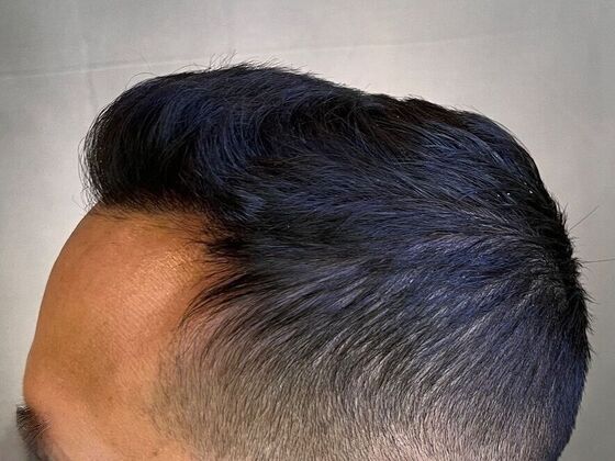 FUE Hair Restoration: Case 26 - After