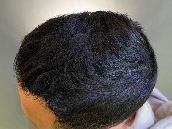 FUE Hair Restoration: Case 26 - After