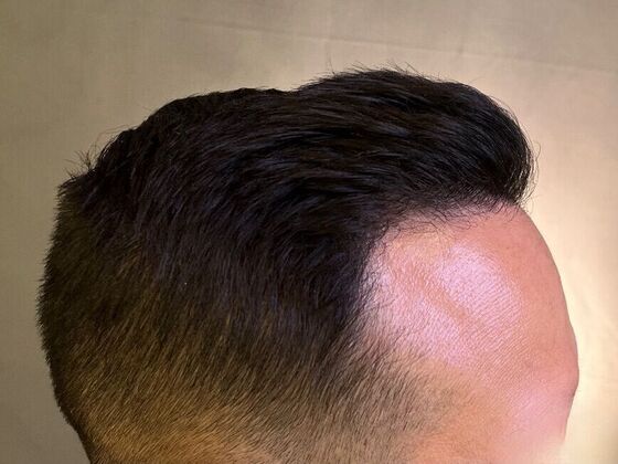 FUE Hair Restoration: Case 26 - After