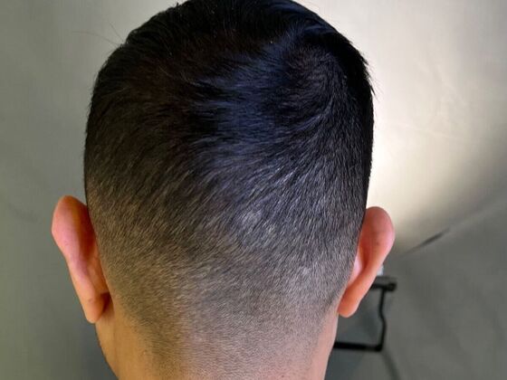 FUE Hair Restoration: Case 26 - After