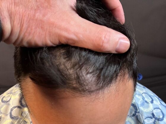 FUE Hair Restoration: Case 26 - Before