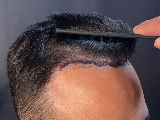 FUE Hair Restoration: Case 26 - Before
