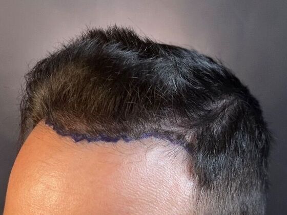 FUE Hair Restoration: Case 26 - Before