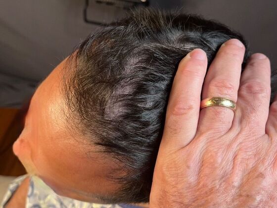 FUE Hair Restoration: Case 26 - Before