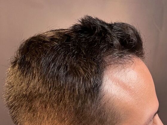 FUE Hair Restoration: Case 26 - Before