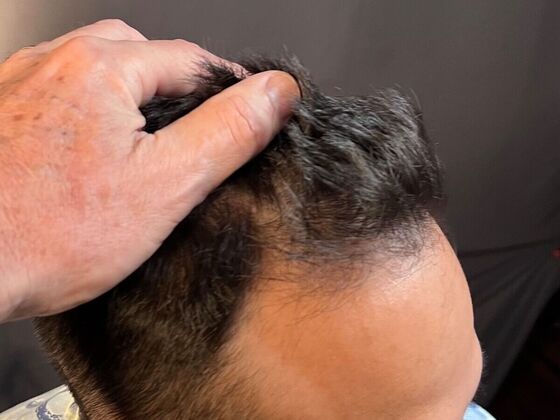 FUE Hair Restoration: Case 26 - Before