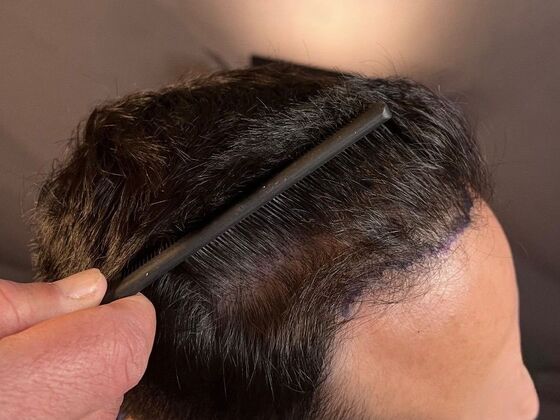 FUE Hair Restoration: Case 26 - Before