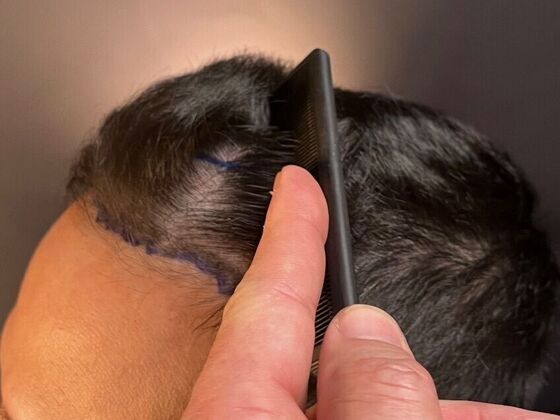 FUE Hair Restoration: Case 26 - Before