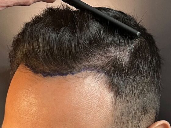 FUE Hair Restoration: Case 26 - Before