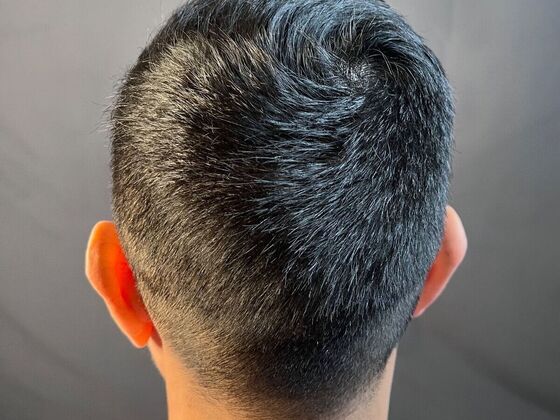 FUE Hair Restoration: Case 26 - Before