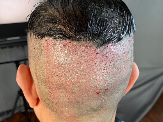 FUE Hair Restoration: Case 26 - Before