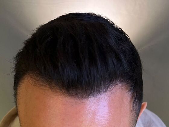 FUE Hair Restoration: Case 26 - After