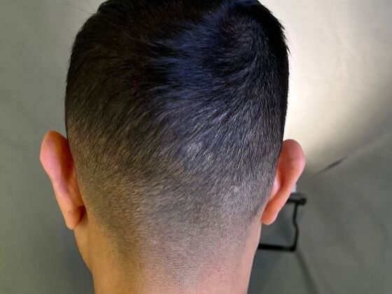 FUE Hair Restoration: Case 26 - After