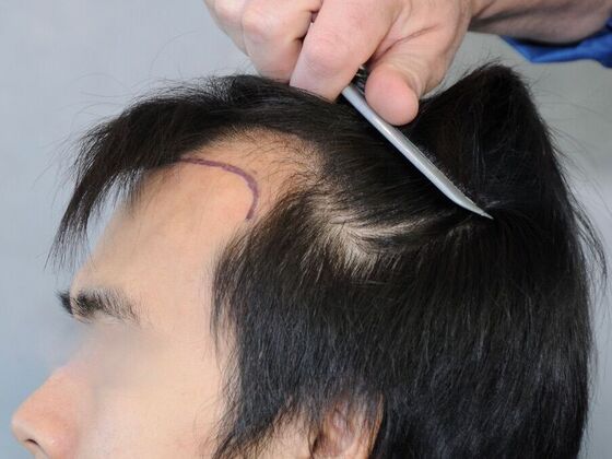 FUT Hair Restoration: Case 31 - Before