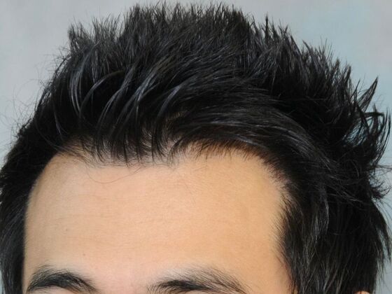 FUT Hair Restoration: Case 31 - Before