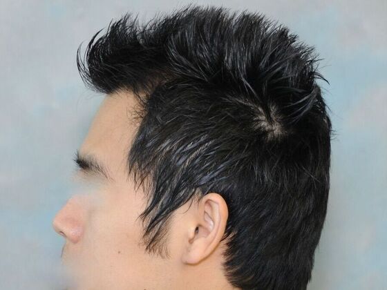 FUT Hair Restoration: Case 31 - After