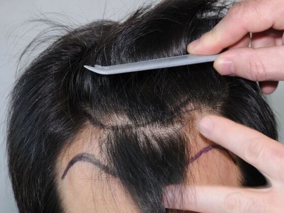 FUT Hair Restoration: Case 31 - Before