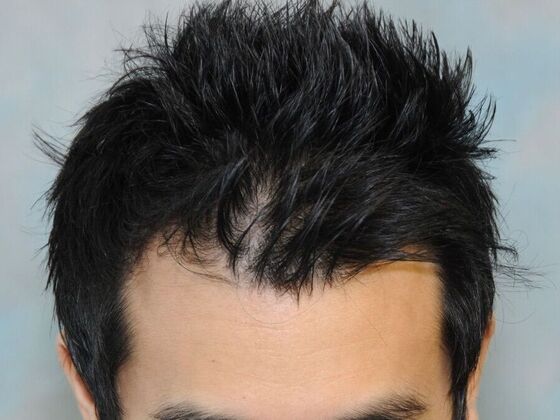 FUT Hair Restoration: Case 31 - After