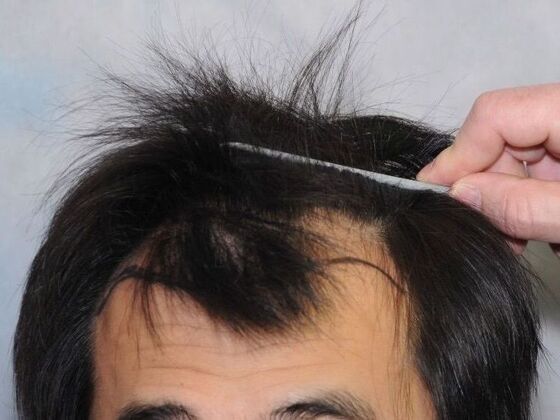 FUT Hair Restoration: Case 31 - After