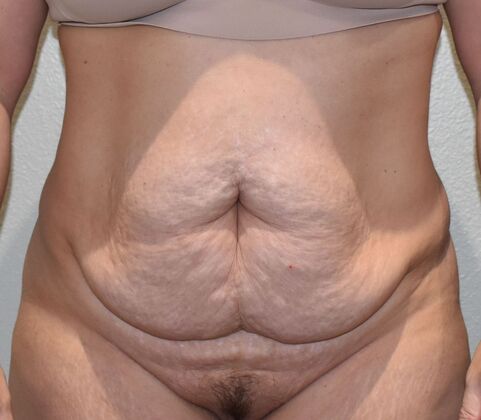 Tummy Tuck (Abdominoplasty): Case 419 - Before