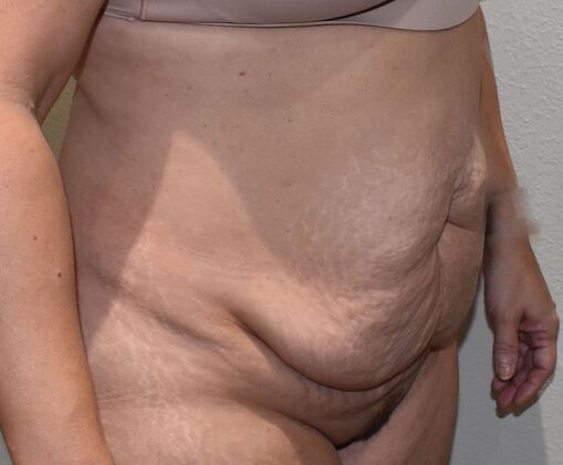 Tummy Tuck (Abdominoplasty): Case 419 - Before