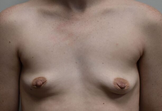 Breast Augmentation Case 744 - Before