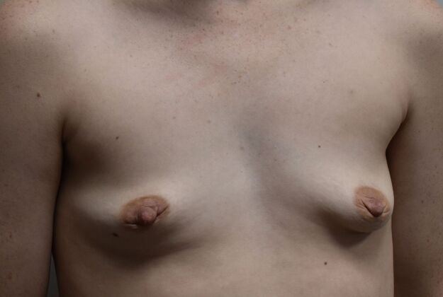 Breast Augmentation: Case 744 - Before