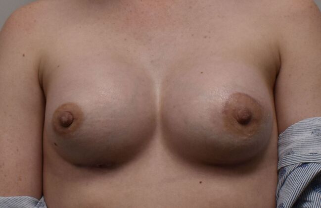 Breast Augmentation w/ Lift Case 496 - After