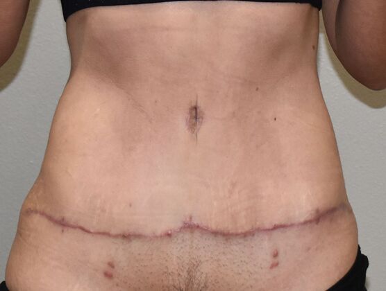 Tummy Tuck (Abdominoplasty): Case 420 - After