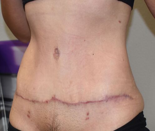 Tummy Tuck (Abdominoplasty): Case 420 - After