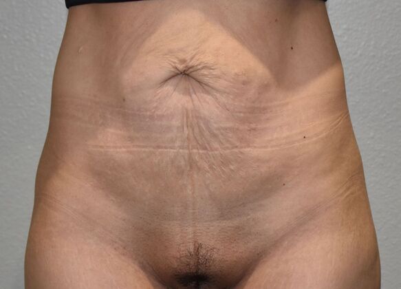 Tummy Tuck (Abdominoplasty): Case 420 - Before