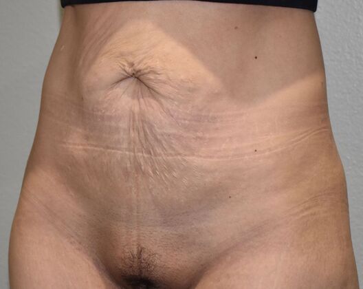 Tummy Tuck (Abdominoplasty): Case 420 - Before
