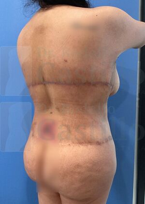 Upper Body Lift: Upper Body Lift: Extended Breast and Arm Lift+ Posterior upper body lift - After