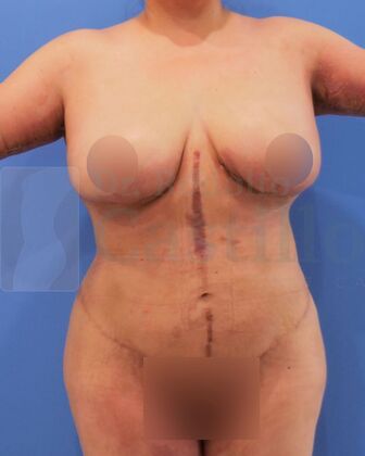 Upper Body Lift: Upper Body Lift: Extended Breast and Arm Lift+ Posterior upper body lift - After