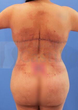 Upper Body Lift: Upper Body Lift: Extended Breast and Arm Lift+ Posterior upper body lift - After 2 weeks