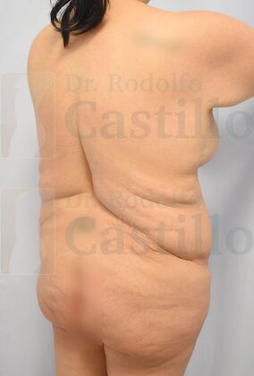 Upper Body Lift: Upper Body Lift: Extended Breast and Arm Lift+ Posterior upper body lift - Before