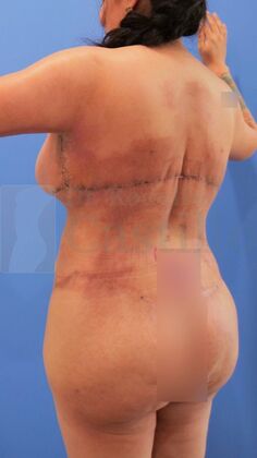 Upper Body Lift: Upper Body Lift: Extended Breast and Arm Lift+ Posterior upper body lift - After