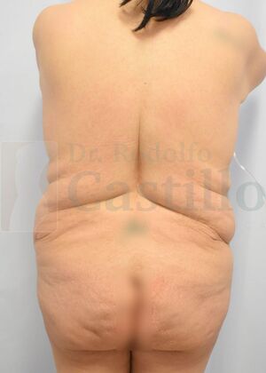 Upper Body Lift: Upper Body Lift: Extended Breast and Arm Lift+ Posterior upper body lift - Before