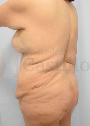 Upper Body Lift: Upper Body Lift: Extended Breast and Arm Lift+ Posterior upper body lift - Before