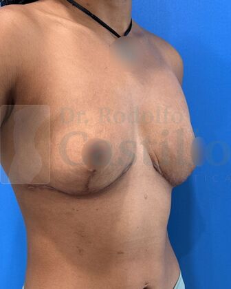 Breast Reduction: Patient with breast reduction + Weight loss - After 1 year