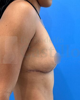 Breast Reduction: Patient with breast reduction + Weight loss - After 1 year