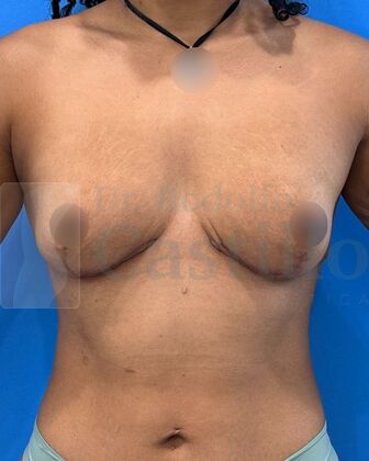 Breast Reduction: Patient with breast reduction + Weight loss - After 1 year