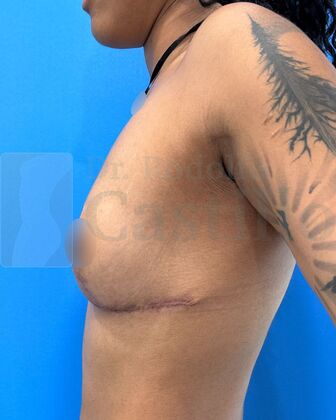 Breast Reduction: Patient with breast reduction + Weight loss - After 1 year