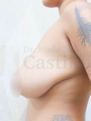 Breast Reduction: Patient with breast reduction + Weight loss - Before
