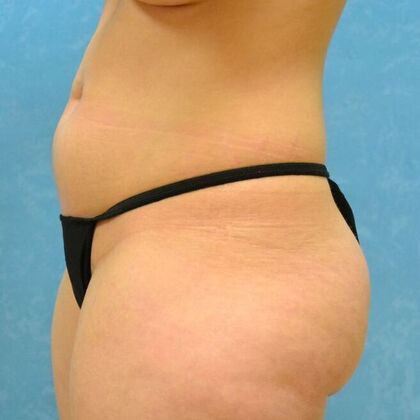 Coolsculpt: Case 1333- Holland, OH - Before