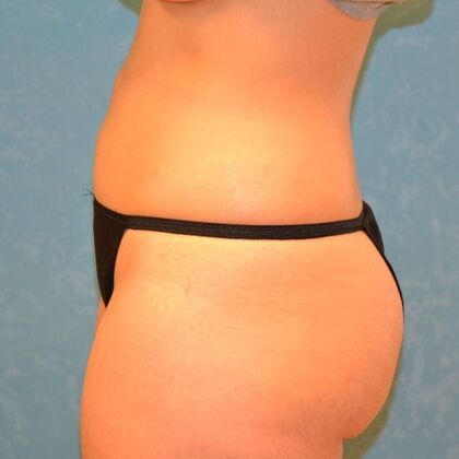 Coolsculpt: Case 1333- Holland, OH - After