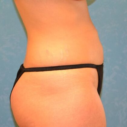 Coolsculpt: Case 1333- Holland, OH - After