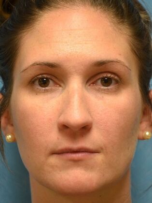 Rhinoplasty Case 1500- Blissfield, MI - Before