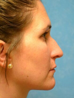 Rhinoplasty: Case 1500- Blissfield, MI - Before