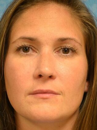 Rhinoplasty Case 1500- Blissfield, MI - After